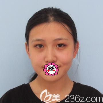 到哈尔滨索菲用耳软骨隆鼻前 到哈尔滨索菲用耳软骨隆鼻前