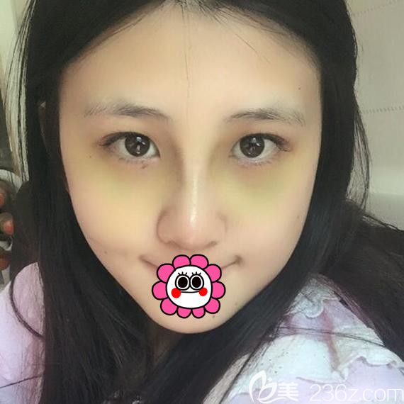 哈尔滨索菲隆鼻拆线后案例 哈尔滨索菲隆鼻拆线后案例