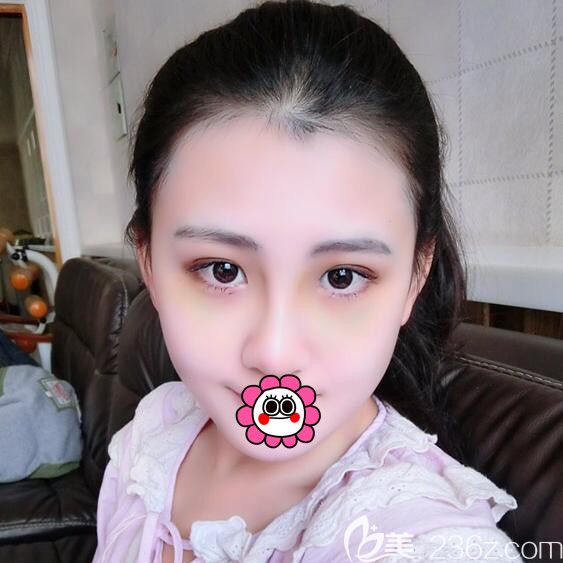 耳软骨隆鼻术后半个月 耳软骨隆鼻术后半个月