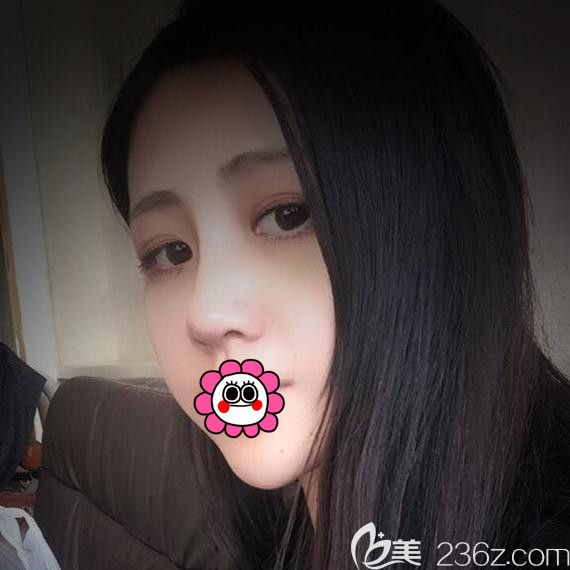 陈富全耳软骨隆鼻术后恢复效果 陈富全耳软骨隆鼻术后恢复效果