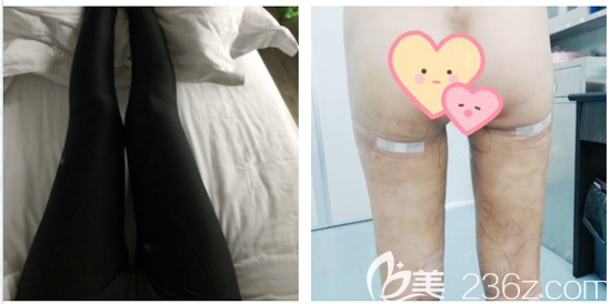 深圳仁安雅大腿吸脂修复术后7天恢复图片