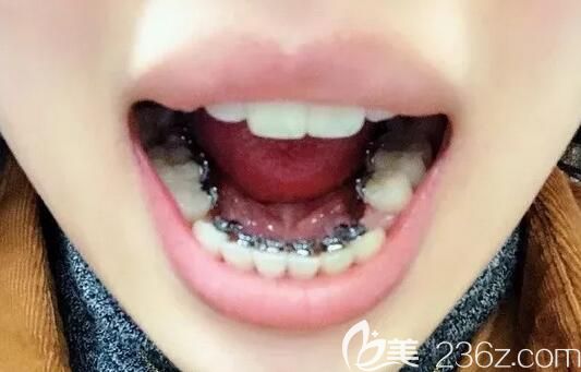 我在南京博韵口腔做牙齿矫正第9个月