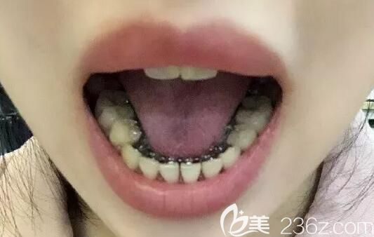 趁着南京博韵口腔价格优惠去做了舌侧隐形牙齿矫正，看下1年的正畸效果怎么样