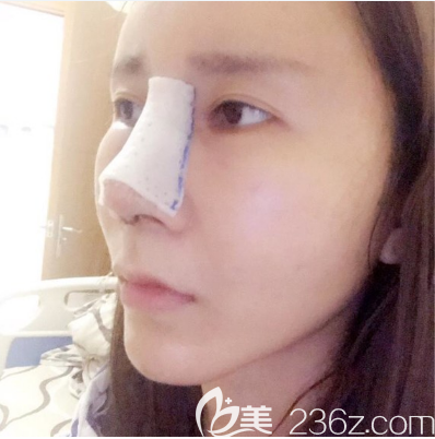 李闯肋骨鼻综合隆鼻术后两天<span style= 李闯肋骨鼻综合隆鼻术后两天<span style=