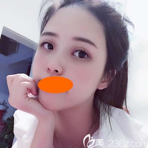 赣州华美整形路卫国院长给我割双眼皮+隆鼻术后5天