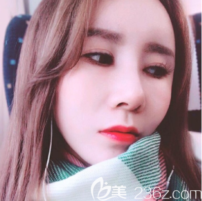 李闯院长全肋骨鼻综合隆鼻术后7天拆线 李闯院长全肋骨鼻综合隆鼻术后7天拆线