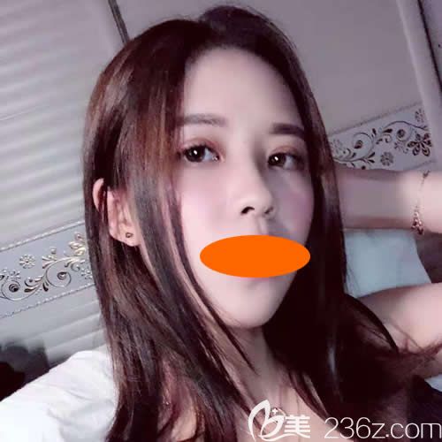 赣州华美整形路卫国院长给我割双眼皮+隆鼻术后第26天