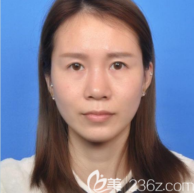 在广州艺美做鼻综合隆鼻前的照片 在广州艺美做鼻综合隆鼻前的照片