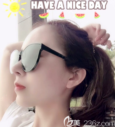 广州艺美李闯做的全肋骨鼻综合隆鼻<span style= 广州艺美李闯做的全肋骨鼻综合隆鼻<span style=