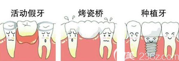 活动假牙、烤瓷桥、种植牙的区别 活动假牙、烤瓷桥、种植牙的区别