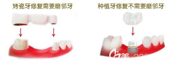 烤瓷牙修复与种植牙修复的优缺点 烤瓷牙修复与种植牙修复的优缺点