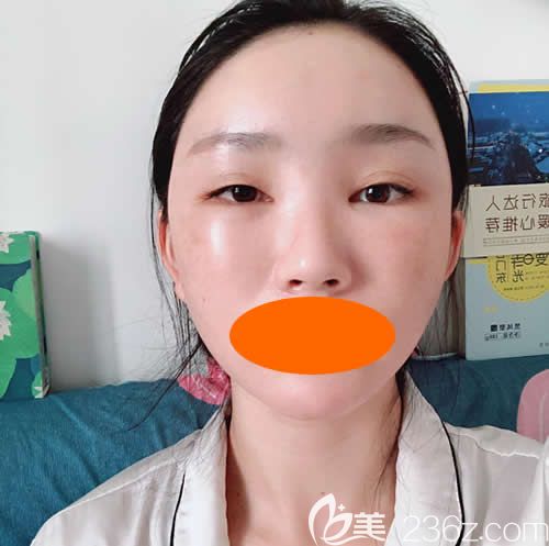 找赣州华美整形路卫国做了自体脂肪填充全脸术后第4天