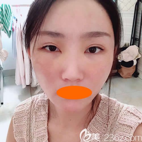 找赣州华美整形路卫国做了自体脂肪填充全脸术后5天