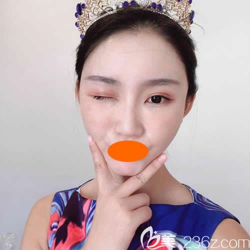 找赣州华美整形路卫国做了自体脂肪填充全脸术后第37天