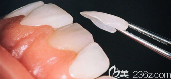 超薄瓷贴面的优势 超薄瓷贴面的优势