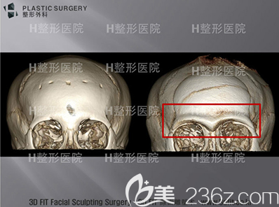 韩国H白汀恒整形医院眉骨整形即刻案例前后效果对比图