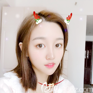 广州海峡李希军做的鼻综合隆鼻一个月<span style= 广州海峡李希军做的鼻综合隆鼻一个月<span style=