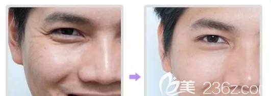北京米兰柏羽丽都液态眼霜小冰瓶祛鱼尾纹案例