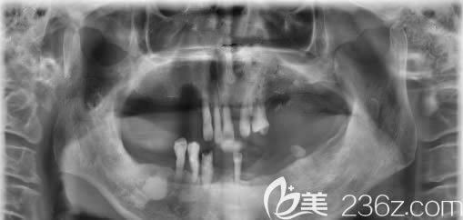 种牙前的CT片 种牙前的CT片