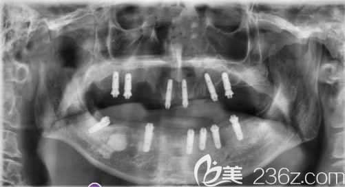 植入口内的12颗韩国奥齿泰种植体 植入口内的12颗韩国奥齿泰种植体