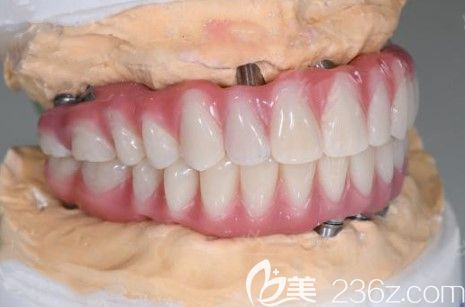 广州广大口腔刘国辉医生给我定制的全口牙冠 广州广大口腔刘国辉医生给我定制的全口牙冠