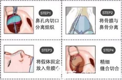 叶武峰院长做鼻部整形手术步骤示意图