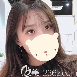 朱医生做眼部综合整形术后56天双眼皮和眼角恢复自然 朱医生做眼部综合整形术后56天双眼皮和眼角恢复自然