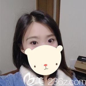 做眼综合整形术后12天眼部肿胀消除眼角疤痕渐消 做眼综合整形术后12天眼部肿胀消除眼角疤痕渐消