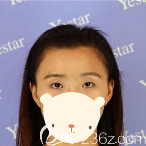 到武汉艺星做眼部综合整形术前眼部无神的自己 到武汉艺星做眼部综合整形术前眼部无神的自己