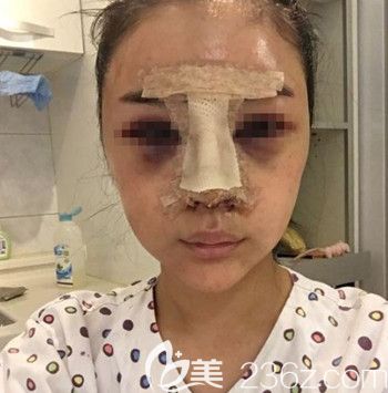 在韩国Nano做的肋骨鼻修复当天