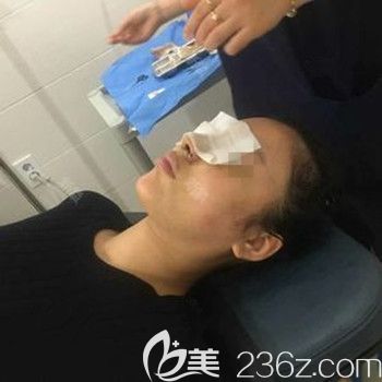 在韩国Nano做的肋骨鼻修复后4天