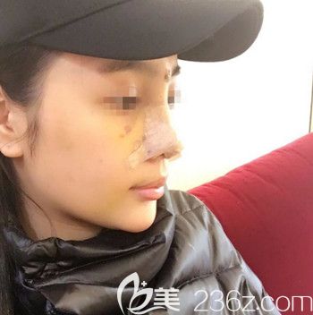 在韩国Nano做的肋骨鼻修复后7天