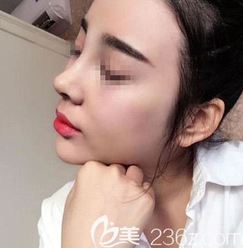 在韩国Nano做的肋骨鼻修复后12天