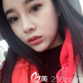 在韩国Nano做的肋骨鼻修复后3个月