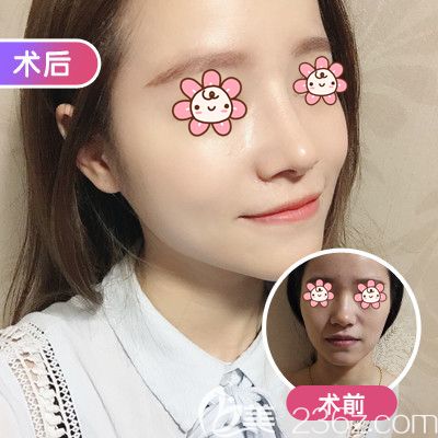 武汉美基元做鼻综合整形术前术后对比效果 武汉美基元做鼻综合整形术前术后对比效果