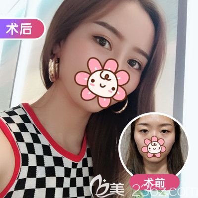 美基元双眼皮整形真人案例术后恢复情况 美基元双眼皮整形真人案例术后恢复情况
