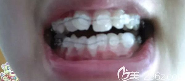 戴上陶瓷半隐形托槽第1天
