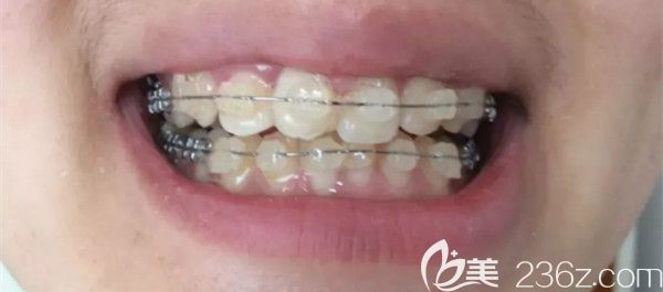 半隐形托槽第100天变化图