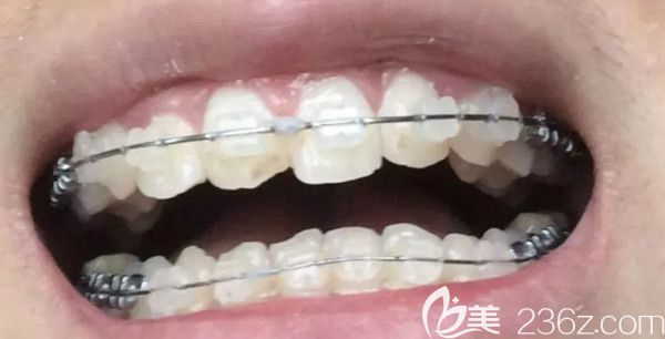 牙齿矫正第5个月效果图