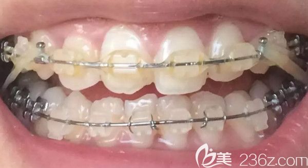 戴牙套第2年牙齿的照片