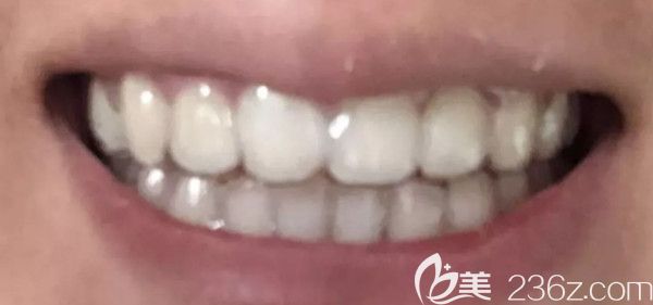 重庆哪个医院矫正牙齿比较好？看门牙歪+牙缝大的我在团圆口腔做陶瓷半隐形矫正的效果