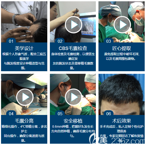 广州荔医植发陆昌龙医生植发过程图 广州荔医植发陆昌龙医生植发过程图