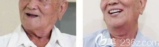 湛江致美口腔周东风院长解答高龄老人能种牙吗