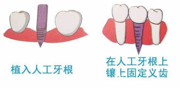 湛江致美口腔曾玉珠医生解答关于种植牙的相关知识