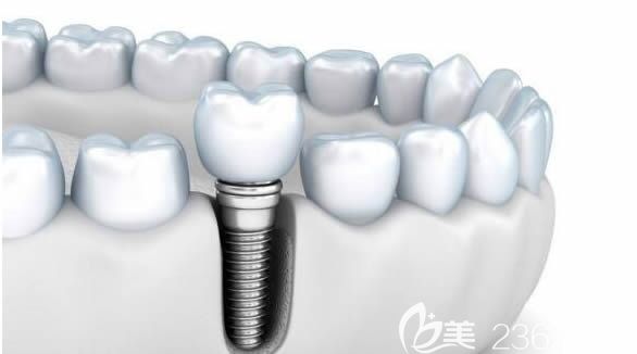 种植牙价格需要多少钱一颗