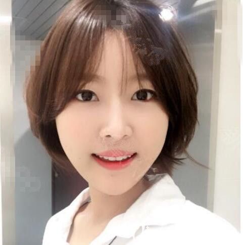 韩国美迪莹徐范信：无金属颧骨缩小术下颌角下巴后，少女感自带