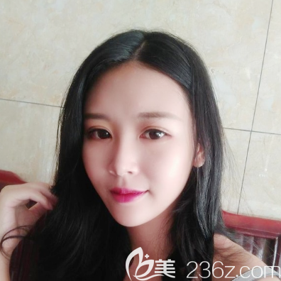 邹顺禄医生全脸自体脂肪填充案例术后15天效果 邹顺禄医生全脸自体脂肪填充案例术后15天效果