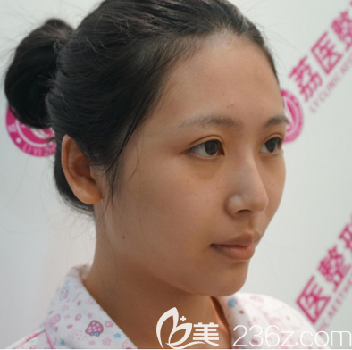 在广州荔医做脂肪填充前的样子 在广州荔医做脂肪填充前的样子