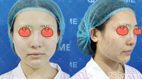 术前嫩牛五方脸的照片 术前嫩牛五方脸的照片