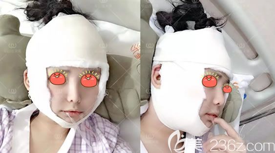 刚做完长曲线下颌角切除术图片 刚做完长曲线下颌角切除术图片